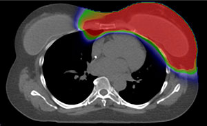 Proton Therapy For Breast Cancer | Texas Center For Proton Therapy